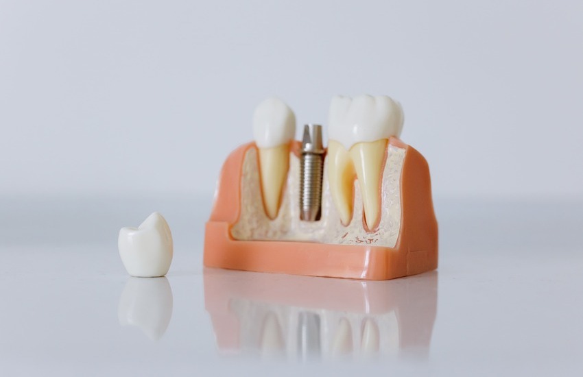 ¿Poner implantes dentales duele?