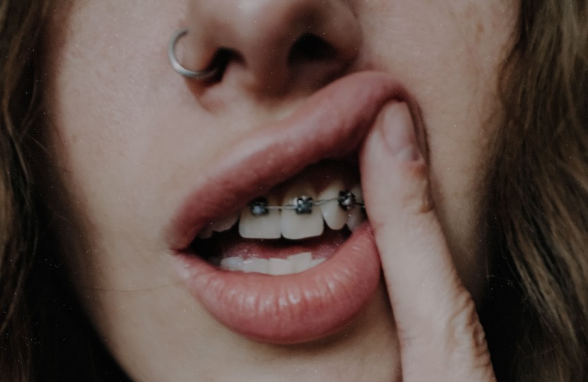 Dientes apiñados