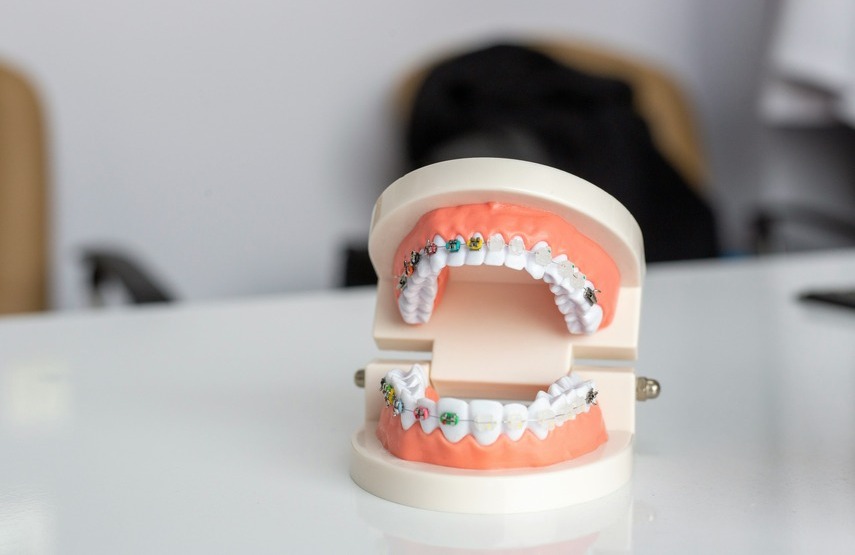 Tratar la sobremordida con brackets